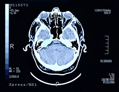 Afbeelding van een hersenscan